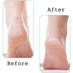 ⁦اداة يدوية لتقشير كعب القدم وإزالة الجلد الميت للحصول علي نعومة بشرة الأطفال عملية وسهلة الأستخدام⁩ - الصورة ⁦5⁩